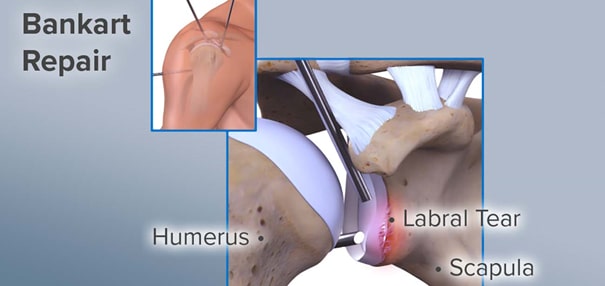 Artroskopik Bankart Onarımı